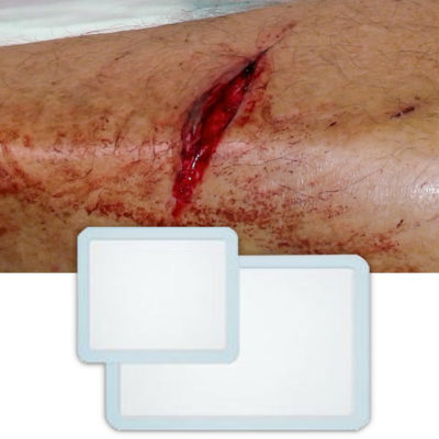 absorbant dressing and wound example