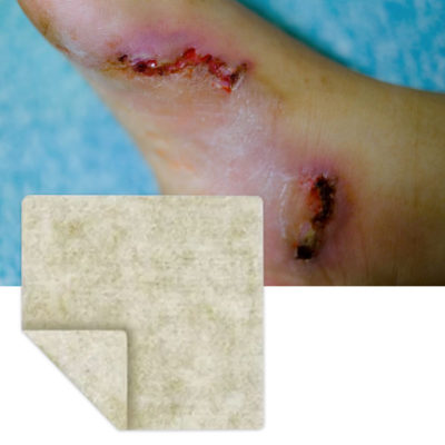 alignate dressing and wound example