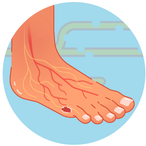 Neuropathic Ulcer icon Neuropathic Ulcer icon