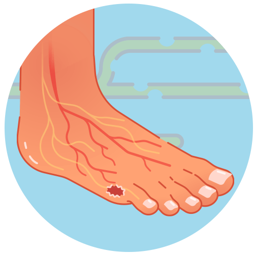 Diabetic peripheral neuropathy