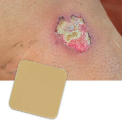 hydrocolloid dressing and wound example