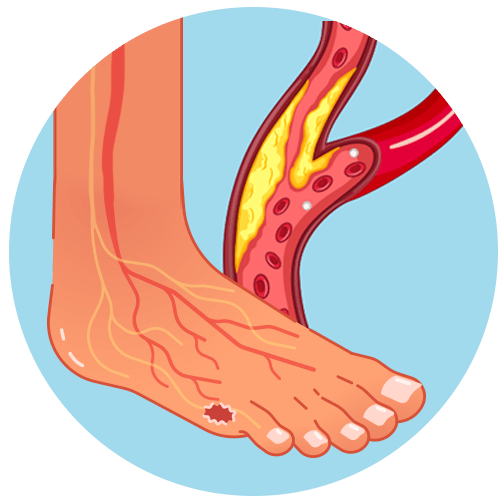 Neuroischemic Ulcer