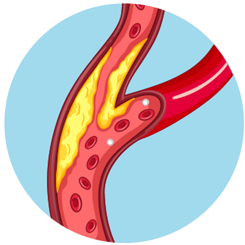 Ichemic Ulcer