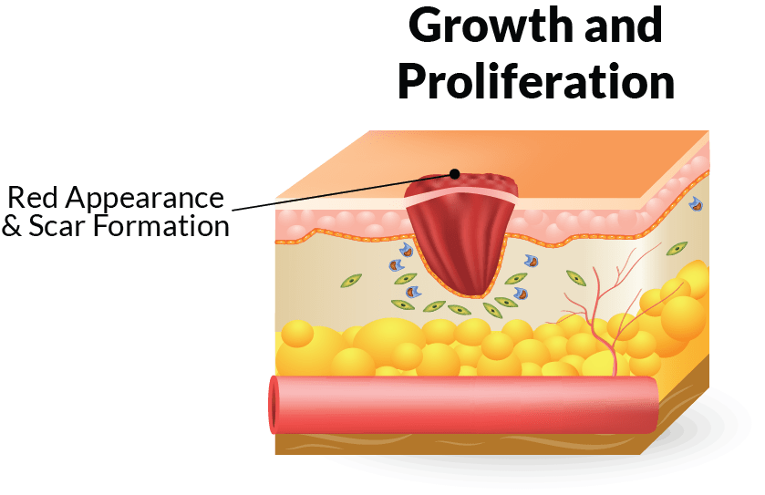 Stage of wound healing - growth and proliferation