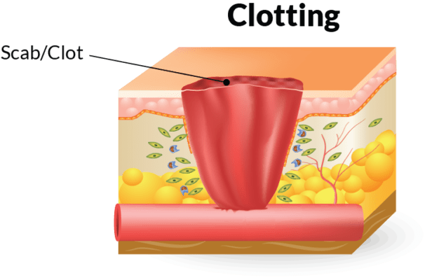 Stage of wound healing - clotting