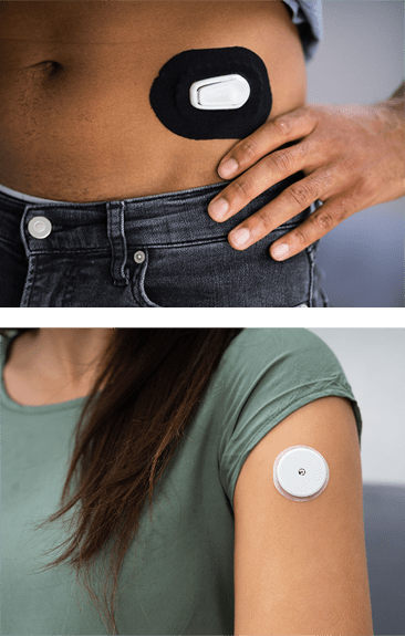 A CGM sensor on the abdomen and on the upper arm