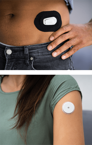 Where to place your CGM sensor A CGM sensor on the abdomen and on the upper arm